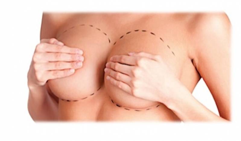 Quanto Custa Cirurgia Prótese para Mama Tatuapé - Prótese de Silicone