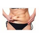 Abdominoplastia com Lipo