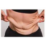 Abdominoplastia em âncora