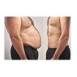 abdominoplastia masculina