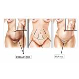 abdominoplastia cirurgia Brooklin