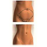 abdominoplastia com lipo Jardim Europa