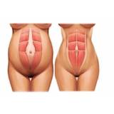 abdominoplastia para diabéticos Cidade Jardim