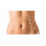 abdominoplastia para retirar estrias valor Vila Mariana