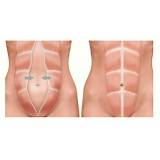 abdominoplastia para retirar estrias Pinheiros