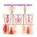 cirurgia intima de labioplastia Jardim Paulista