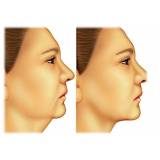 cirurgia plástica de papada preço Santana