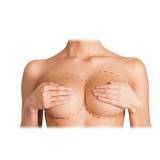 cirurgia plástica mamoplastia