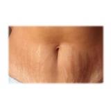 clínica de abdominoplastia para retirar estrias Moema