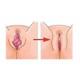 labioplastia feminina Morumbi