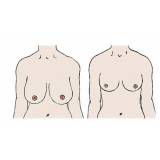mamoplastia corretiva Perdizes