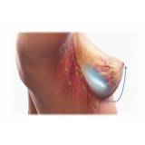 mamoplastia redutora com silicone preço Itaim Bibi