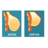 mamoplastia redutora Perdizes