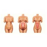 onde encontro abdominoplastia barriga estufada Vila Mariana