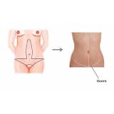 onde encontro abdominoplastia em âncora Perdizes