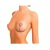 onde encontro mamoplastia redutora levantamento Itaim Bibi