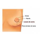 onde encontro mamoplastia redutora Santo André